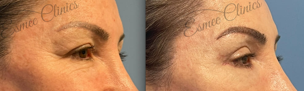 Before and After img